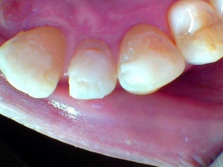 Cosmetic-Bonding-to-Repair-Chipped-Discolored-Teeth-After-Image