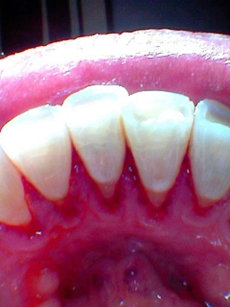 Teeth-Cleaning-Transformation-After-Image