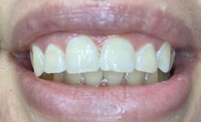 Teeth-Whitening-Transformation-After-Image