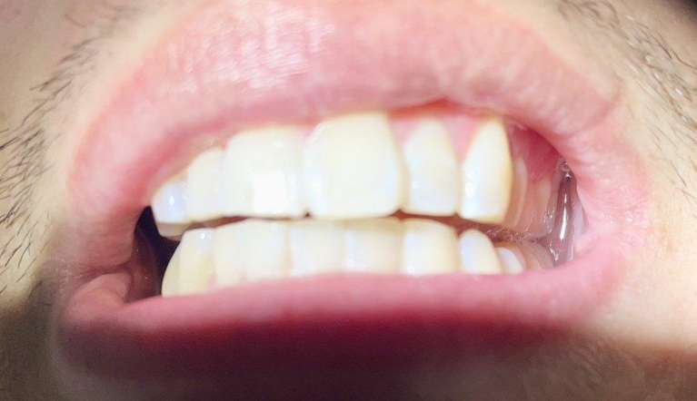 Teeth-Whitening-with-ZOOM-After-Image