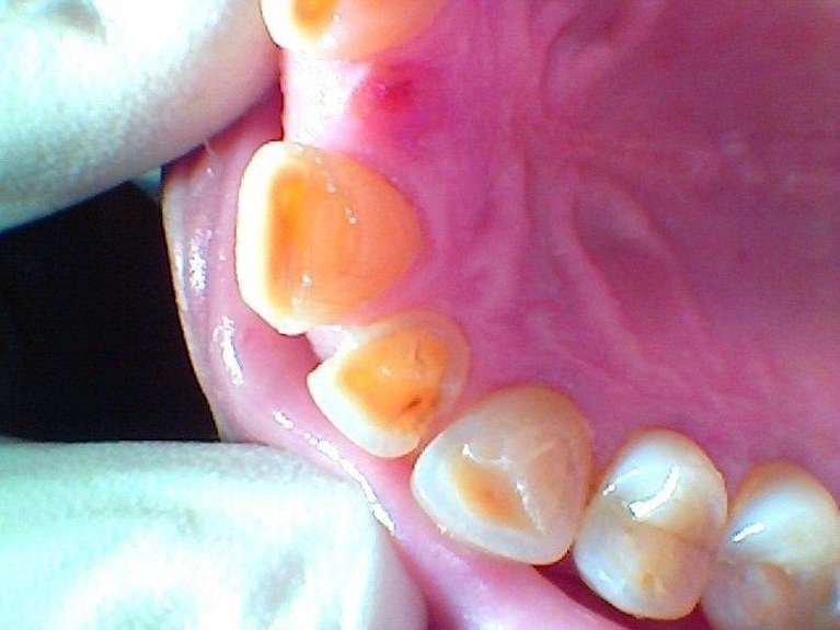 Cosmetic-Bonding-to-Repair-Chipped-Discolored-Teeth-Before-Image