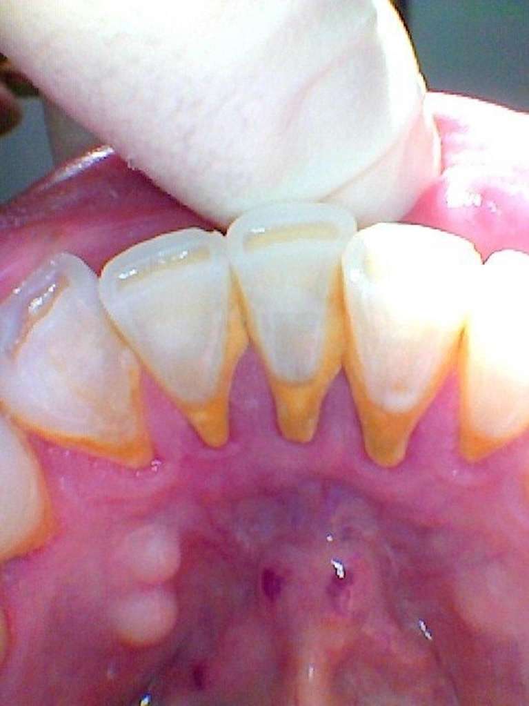 Teeth-Cleaning-Transformation-Before-Image