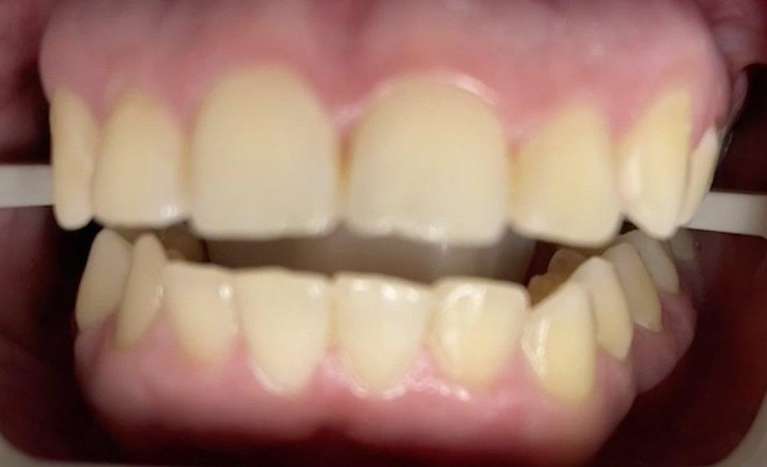 Teeth-Whitening-Transformation-Before-Image