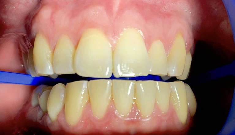 Teeth-Whitening-with-ZOOM-Before-Image